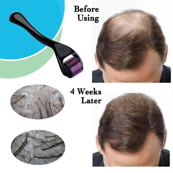 Derma Roller – Reduce Fine Lines for Smooth Skin